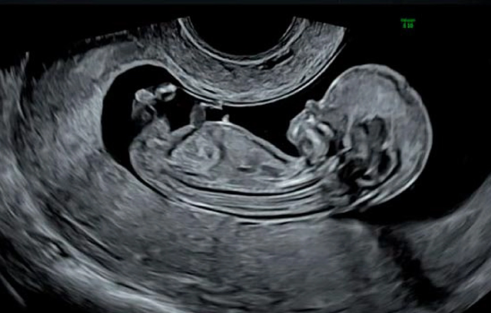 Imagen de una ecográfica genética de feto de alrededor de 3 meses.
