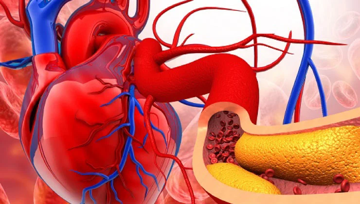La imagen muestra una ilustración del corazón y una arteria obstruida por acumulación de colesterol. Se destacan las arterias y venas conectadas al corazón, y un corte transversal de una arteria con placa amarilla que reduce el flujo sanguíneo. Es una representación común para explicar los efectos del colesterol alto en la salud cardiovascular.