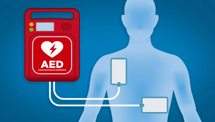 muestra un esquema de un desfibrilador externo automático (DEA) conectado a un torso humano. Se ven las almohadillas del DEA colocadas en el lado superior derecho y el lado inferior izquierdo del pecho.