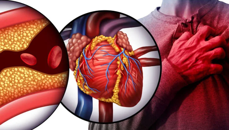 La imagen muestra una ilustración del corazón y una arteria obstruida por acumulación de colesterol. Se destacan las arterias y venas conectadas al corazón, y un corte transversal de una arteria con placa amarilla que reduce el flujo sanguíneo. Es una representación común para explicar los efectos del colesterol alto en la salud cardiovascular.