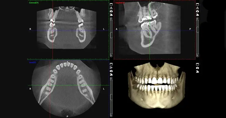 Tomografía computarizada de haz cónico, Cone Beam o CBCT